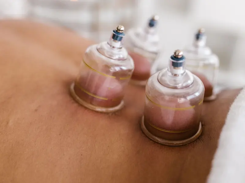 Hijama cupping